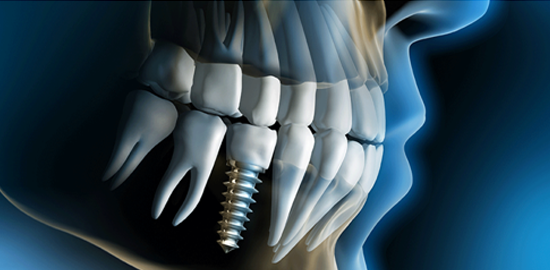 Dental Implant