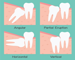 root canal treatment