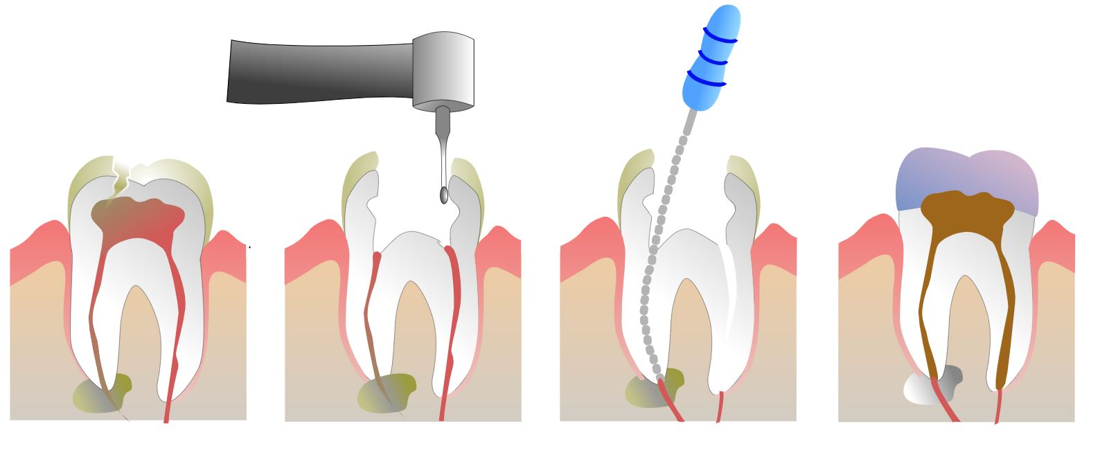 root canal treatment